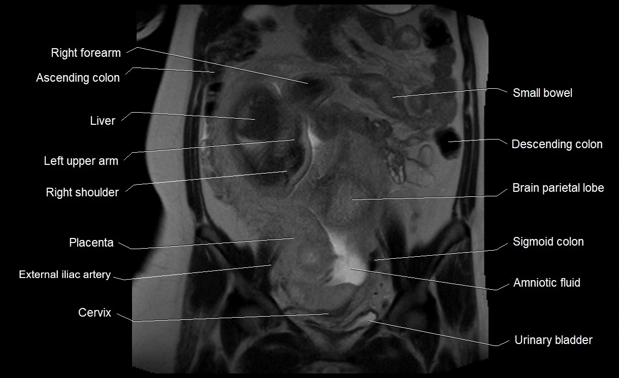 MRI Anatomy of pregnancy image 18.webp
